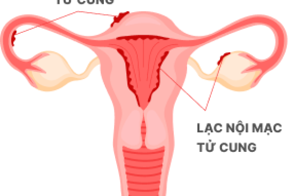 LẠC NỘI MẠC TỬ CUNG LÀ GÌ?