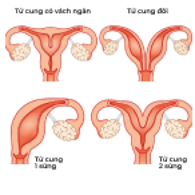 Cấu trúc bất thường của tử cung