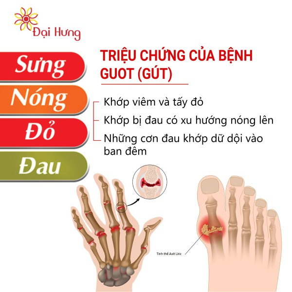 Bệnh Gout và cách điều trị 